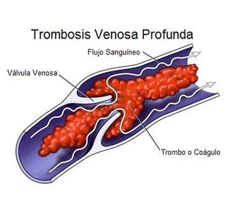 Deep Venous Thrombosis | Cardio Care