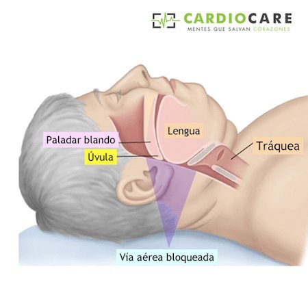 What is the relationship between snoring and sleep apnea? | Cardio Care