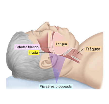 relacion ronquidos apnea del sueño